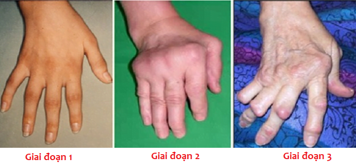 Tổng Quan Về Bệnh Phong, Hiểu Biết Và Cách Điều Trị 3 Benh Phong C1618