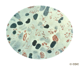 Tổng Quan Về Bệnh Phong, Hiểu Biết Và Cách Điều Trị 1 New Picture 53 1