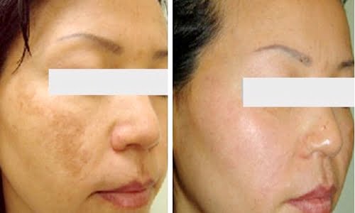 Trị Nám Da Hiệu Quả Bằng Công Nghệ Laser Q-Swich Alexandrite Tại Bệnh Viện Da Liễu Hà Nội 1 Dieu Tri Nam Da 1 2