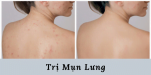 Tri Mun Lung