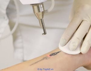 Dia Chi Xoa Hinh Xam Tai Tphcm