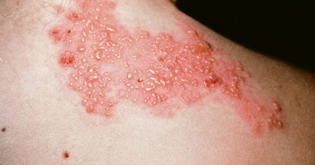 Những Tổn Thương Cơ Bản Ngoài Da 1 083045 Mun Nuoc La Benh Gi