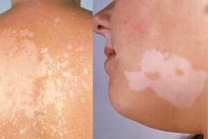 20210805 Dieu Tri Lang Ben 1