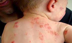 Chẩn Đoán, Biện Pháp Điều Trị Chốc 1 6