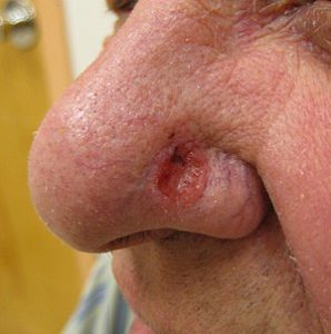 Basal Cell Carcinoma2