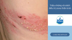 Trieu Chung Va Cach Dieu Tri Zona Than Kinh
