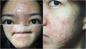 Da Nhiem Corticoid Nguy Hiem Khong