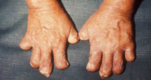 Di Chung Tan Tap Cua Benh Phong