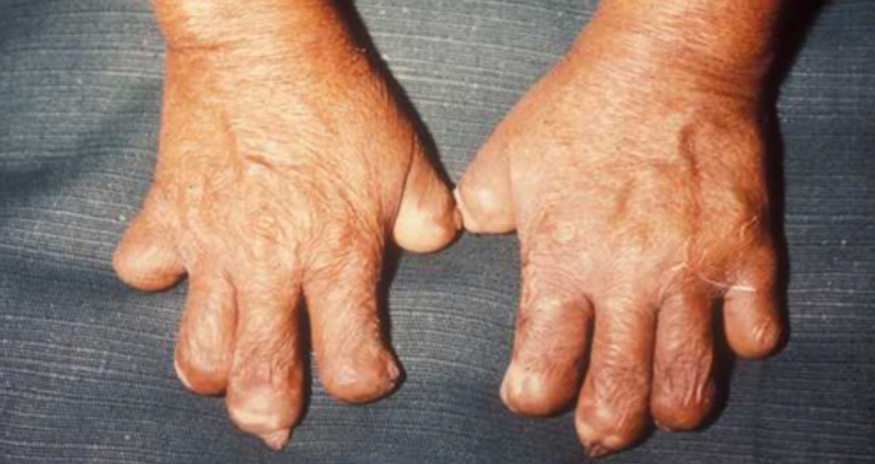 Di Chung Tan Tap Cua Benh Phong