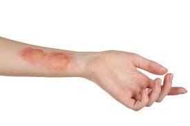 Chẩn Đoán Và Điều Trị Hội Chứng Stevens - Johnson 1 Download 3