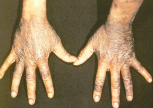 Pellagra Pictures Symptoms Treatment Causes