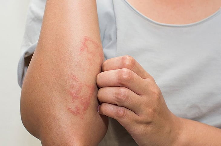 Chẩn Đoán Và Điều Trị Viêm Da Tiếp Xúc Do Côn Trùng 1 Viem Da Do Tiep Xuc Con Trung