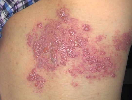 Điều Trị Và Dự Phòng Bệnh Zona 1 Zona