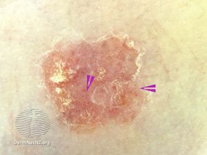 Chẩn Đoán Ung Thư Biểu Mô Tế Bào Vảy 3 1