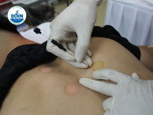 Cấy Chỉ Hỗ Trợ Điều Trị Bệnh Vảy Nến 1 6