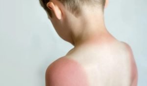 Bỏng Nắng 2 Bong Nang 1