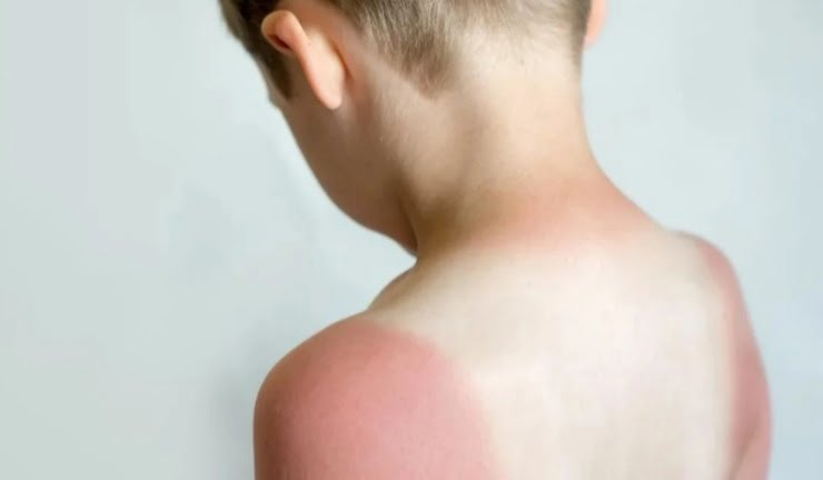 Bỏng Nắng 1 Bong Nang 1