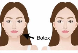 Thon Gọn Cơ Cắn- Làm Đẹp Nhanh Và Hiệu Quả 12 2