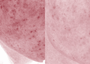 Hồng Ban Sau Mụn – Vấn Đề Thẩm Mỹ Cần Được Quan Tâm Đúng Lúc 12 3