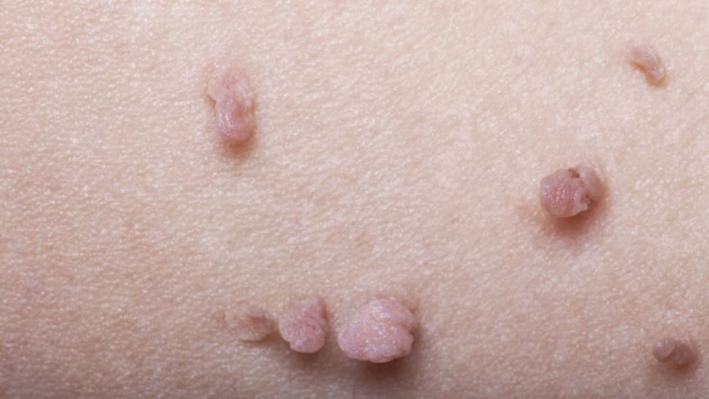 U Nhu Tren Da Co Nguy Hiem Hay Khong Phuong Phap Dieu Tri U Nhu Tren Da 6047C79D04